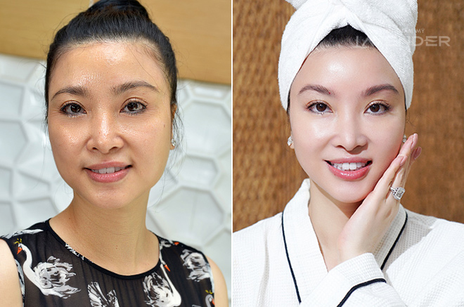 Người giàu Việt Nam làm đẹp bằng phương pháp đắt đỏ đến đâu? - 9