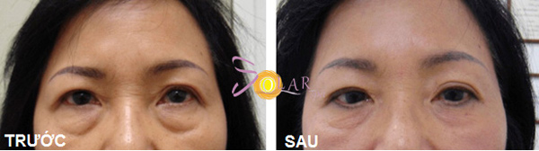 Xoá bọng mỡ mắt không phẫu thuật trong 90 phút - 2