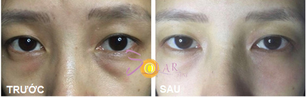 Xoá bọng mỡ mắt không phẫu thuật trong 90 phút - 3