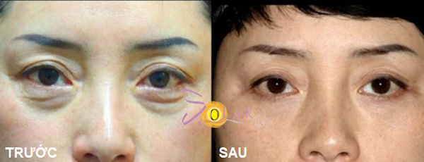 Xoá bọng mỡ mắt không phẫu thuật trong 90 phút - 4