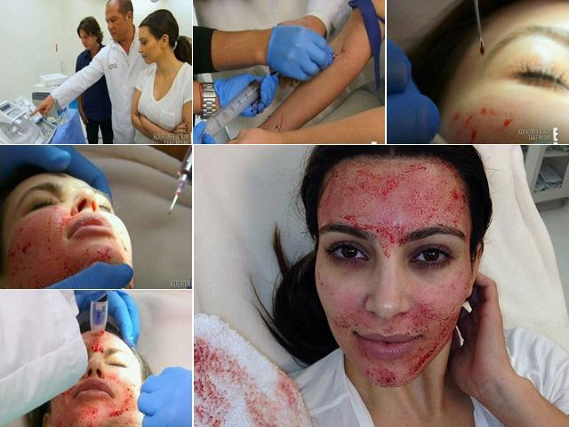 Làm đẹp - Mát-xa bằng đỉa, đắp mặt nạ máu để đẹp như Kim "siêu vòng 3"...