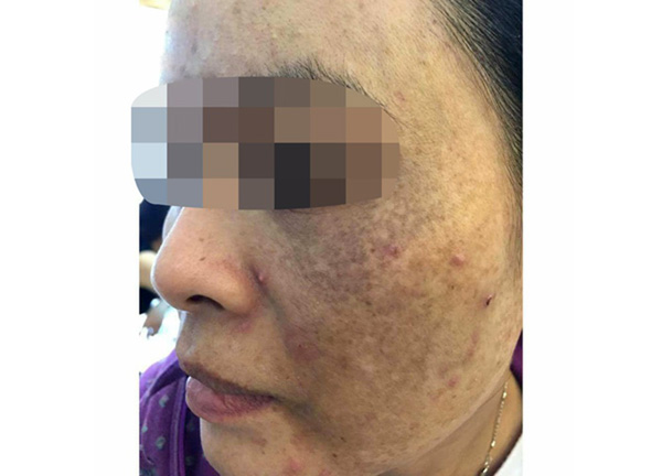 Ưu điểm của Đông y đối với nám da và tàn nhang - 1