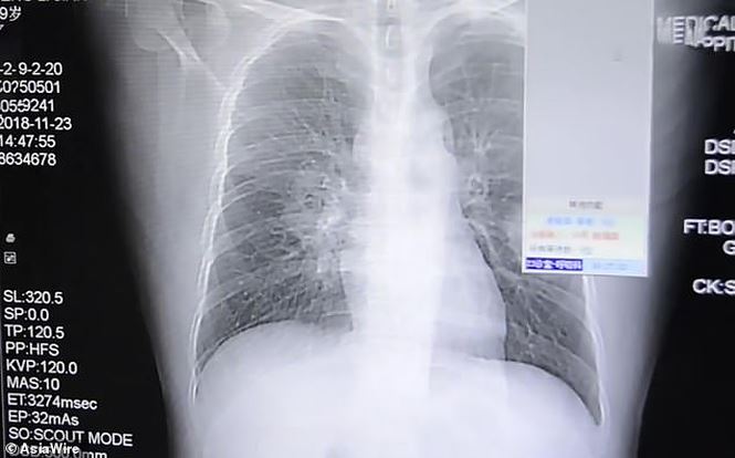 Nghiện mùi ‘tất thối’, chàng trai nhập viện do nhiễm nấm phổi - 1