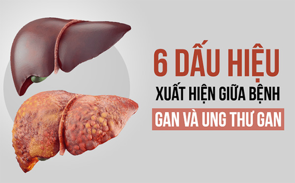 "Thoát" men gan cao, biến chứng xơ gan, ung thư gan cận kề - 2