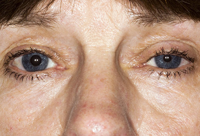 8. Những vấn đề về mắt: Các khối u Pancoast cũng có thể ảnh hưởng đến các dây thần kinh đến mắt và một phần khuôn mặt của bạn. Đây được gọi là hội chứng Horner. Các triệu chứng bao gồm: con ngươi ở một trong hai mắt của bạn với một mí mắt rũ xuống. Thậm chí khi bạn khóc, nước mắt ở bên mắt đó không thể chảy ra.