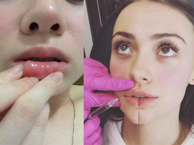 Làm đẹp - Đua nhau đi tiêm filler, nhiều chị em môi cứng đơ như bàn thạch