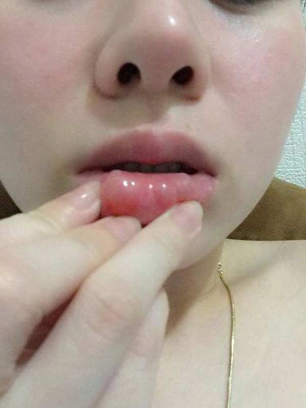 Đua nhau đi tiêm filler, nhiều chị em môi cứng đơ như bàn thạch - 2