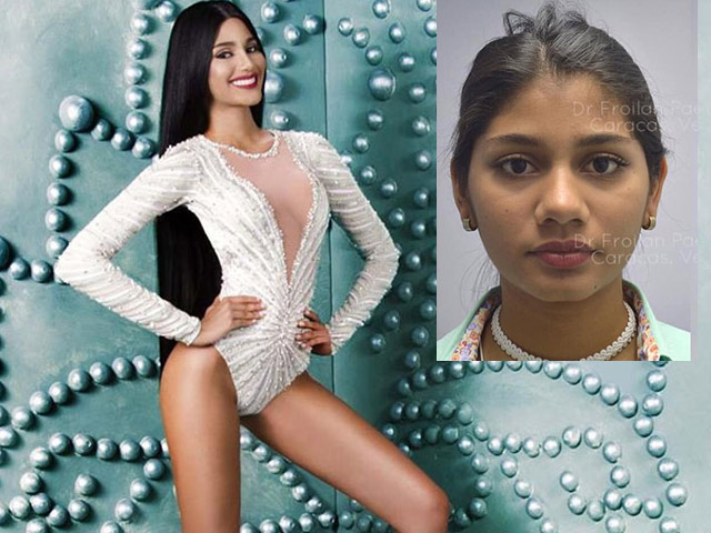 Làm đẹp - Bằng chứng mũi, cằm, trán "giả" của Hoa hậu Venezuela thắng H'Hen Niê trong gang tấc