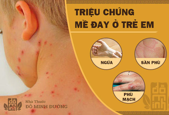Chữa bệnh mề đay ở trẻ em: Mẹ đã biết cách xử lý đúng hay chưa? - 2
