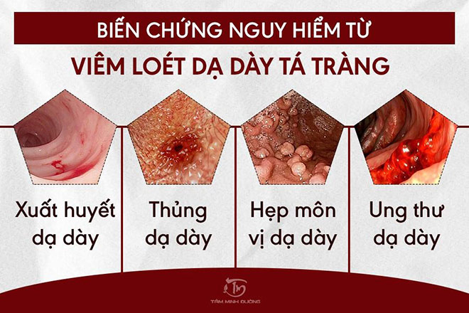 Phòng ngừa tái phát