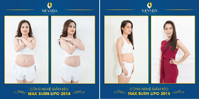 MC Huyền Châu và diễn viên hài Lâm Vỹ Dạ trước và sau khi sử dụng Max Burn Lipo