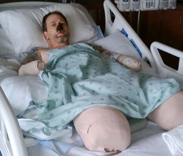 Để chó liếm, người đàn ông phải cắt cụt tứ chi - 1