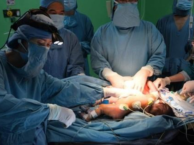 Sức khỏe đời sống - Sau nhiều giờ "đánh vật", các bác sĩ đã tách thành công 2 bé gái dính chặt nhau