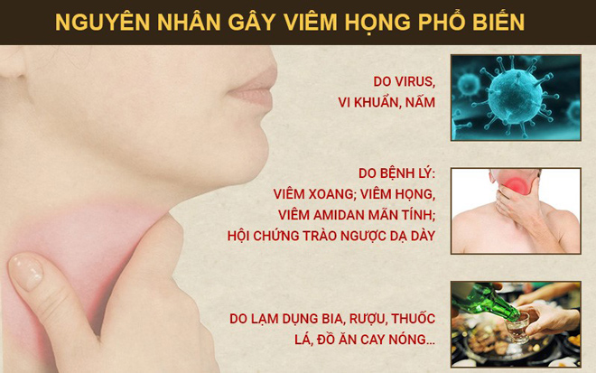 Bệnh viêm họng: Nguyên nhân, dấu hiệu và cách chữa không tái phát - 2