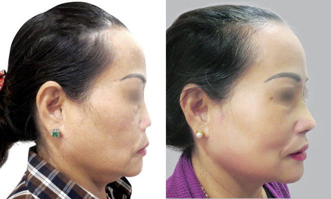 Một khách hàng bị biến chứng mũi do ham thẩm mỹ giá rẻ, đã được tái phẫu thuật thành công