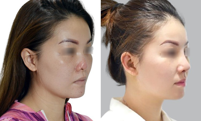 Chiếc bóng đỏ, lộ sóng đã được tái phẫu thuật mũi bằng công nghệ S Line tại JW