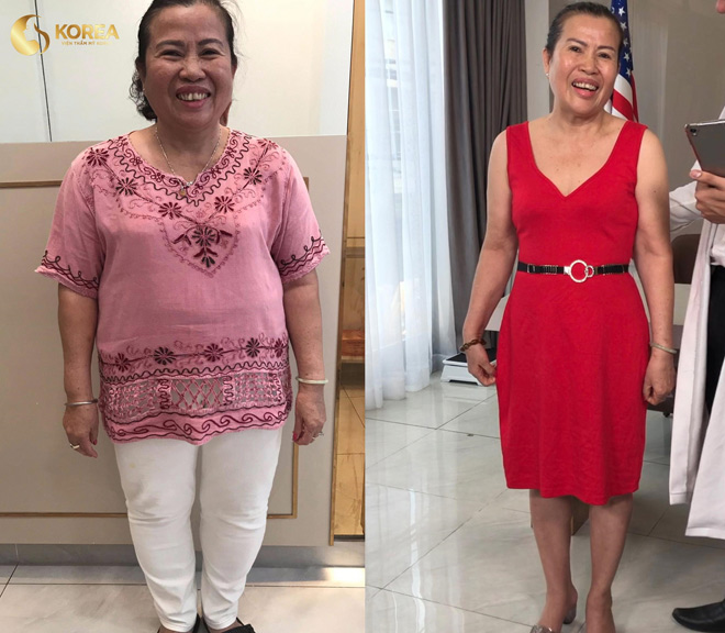 Nhờ công nghệ giảm béo Max Thin Nanomax mà cô Hoa (TP.Vũng Tàu) U70 thay đổi cả về ngoại hình và tinh thần. Cô đã giảm được 9kg, ngủ tròn giấc hơn trước và khoan khoái tận hưởng tuổi già.