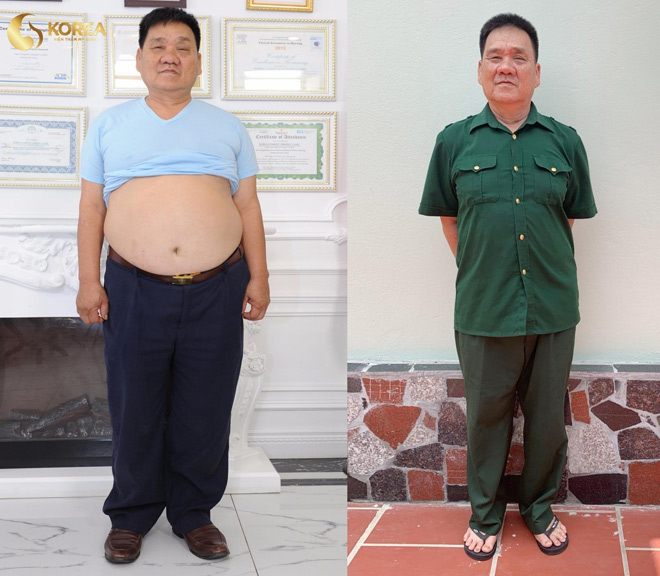 Bác Hoàng (Tam Đảo, Vĩnh Phúc) giảm 12kg nhờ công nghệ giảm béo Max Thin Nanomax. Cuộc sống của bác sau khi giảm hoàn toàn được “thay da đổi thịt”