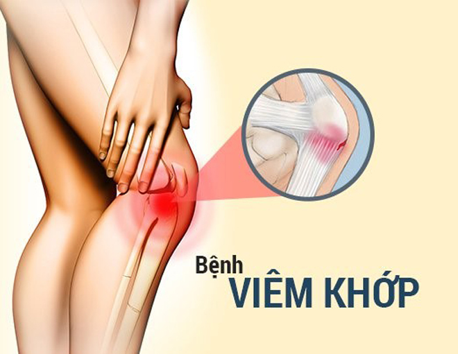 Ảnh minh họa: Bệnh viêm khớp