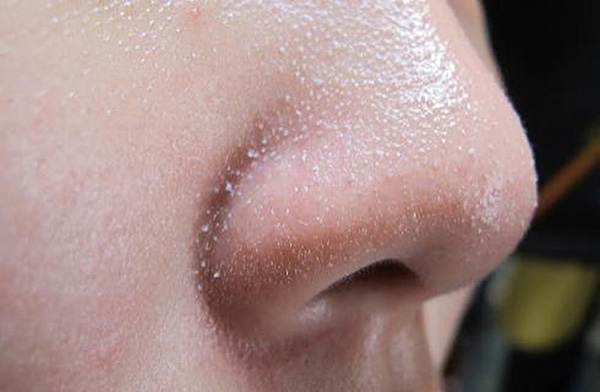 Mụn cám là gì và cách trị hiệu quả lấy lại làn da mịn màng, trắng sáng - 1