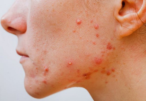 Mụn viêm là gì, nguyên nhân và cách trị hiệu quả, hết sưng đau - 1