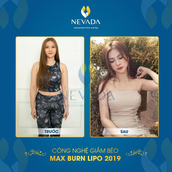 Nữ ca sĩ Thu Thủy giảm cân thành công sau 1 liệu trình Max Burn Lipo