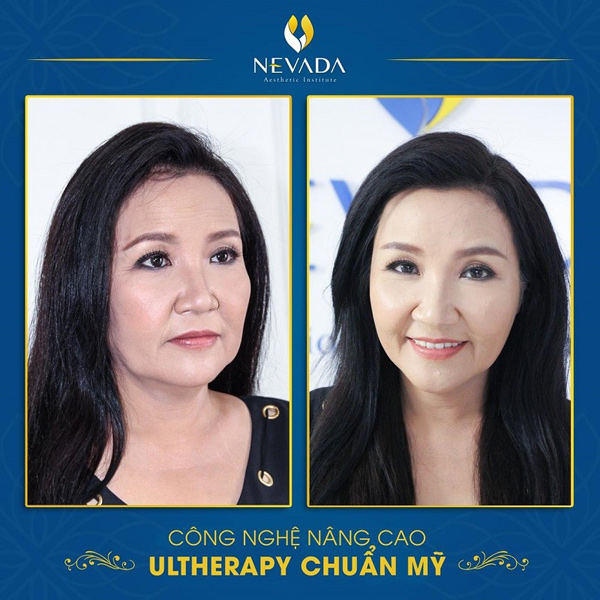 Nghệ sĩ Ngân Quỳnh khắc phục tình trạng lão hóa da nhờ công nghệ Ultherapy