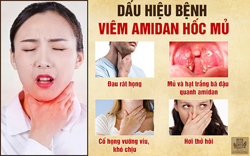 Bệnh viêm amidan hốc mủ: Triệu chứng và cách chữa khỏi không kháng sinh, không cắt - 2