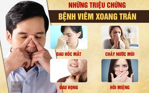 Bệnh viêm xoang trán: Bác sĩ chỉ rõ dấu hiệu và cách chữa khỏi dứt điểm - 2
