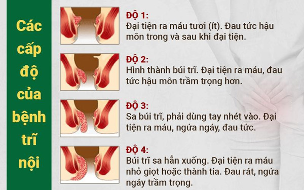 Trĩ nội là gì? Triệu chứng và cách chữa hiệu quả từ y học cổ truyền - 2