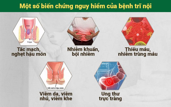 Trĩ nội là gì? Triệu chứng và cách chữa hiệu quả từ y học cổ truyền - 4