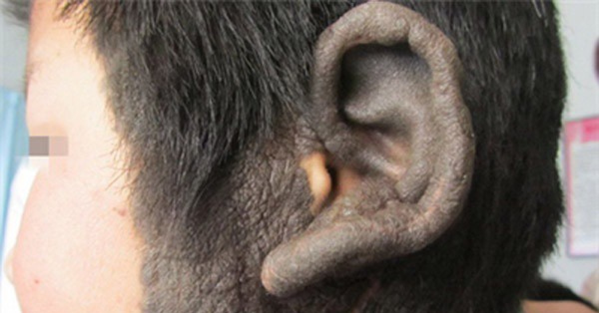 Sức khỏe đời sống - Bé trai 2 tuổi ở Quảng Ninh cả người đen như nhọ nồi vì bệnh cực kỳ hiếm gặp