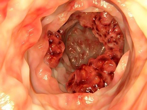 Viêm đại tràng lâu năm có nguy cơ chuyển hóa ung thư đại tràng