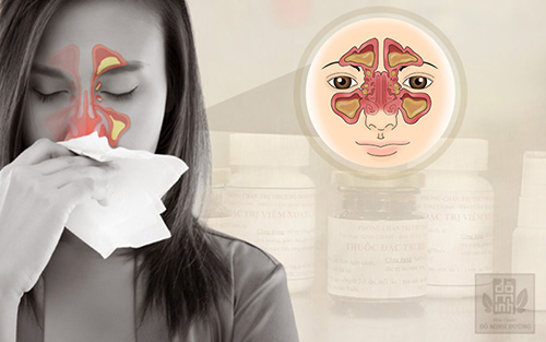 Bệnh viêm đa xoang là gì? Triệu chứng và cách chữa không tái phát - 1