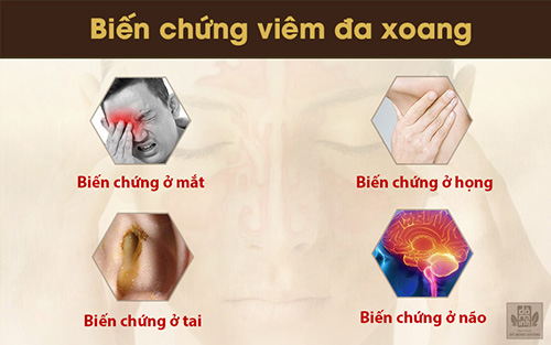 Bệnh viêm đa xoang là gì? Triệu chứng và cách chữa không tái phát - 2