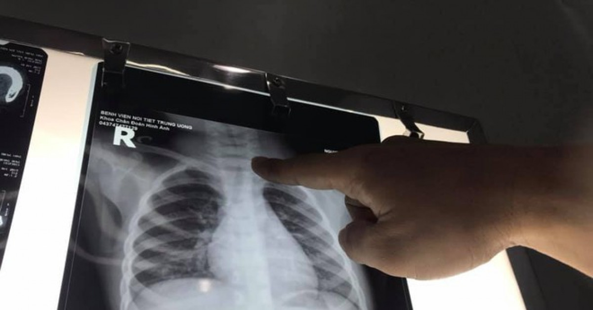 Sức khỏe đời sống - Sốc: Bé 3 tuổi ung thư tuyến giáp di căn