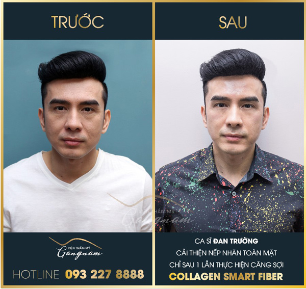 Làn da ca sỹ Đàn Trường trẻ trung, thay đổi rõ rệt sau khi thực hiện căng da bằng chỉ tại viện thẩm mỹ Mega Gangnam