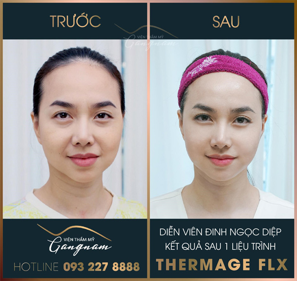 Gương mặt của nữ diễn viên Đinh Ngọc Diệp thay đổi rõ nét sau liệu trình Thermage FLX