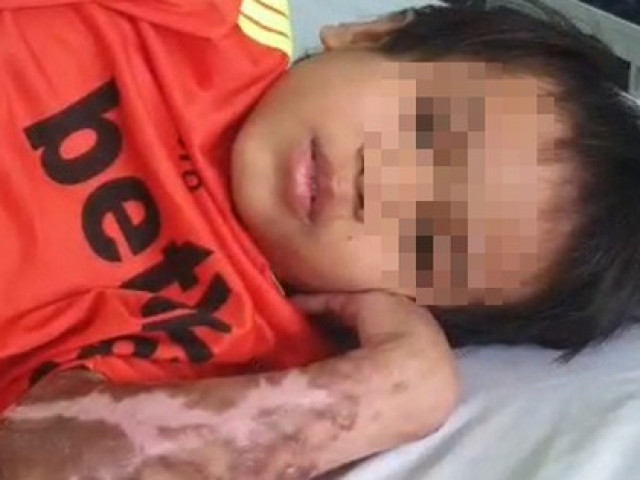 Vụ bác sĩ năn nỉ được cứu chữa cháu bé phỏng nặng: A Huyên đã bình phục, xuất viện