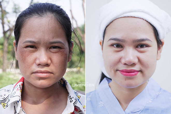 Chị em truyền tai nhau cách trị nám mới: Sạch nám tới 80% mà còn sáng mịn da - 5