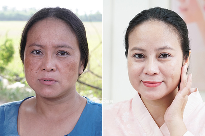 Chị em truyền tai nhau cách trị nám mới: Sạch nám tới 80% mà còn sáng mịn da - 6