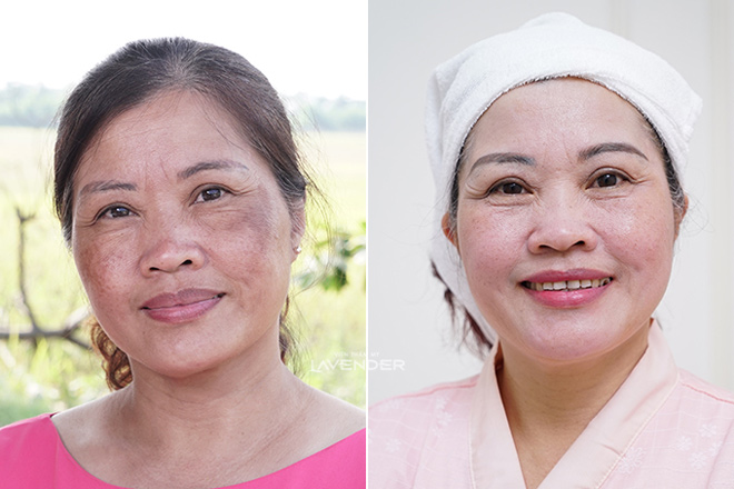 Chị em truyền tai nhau cách trị nám mới: Sạch nám tới 80% mà còn sáng mịn da - 7