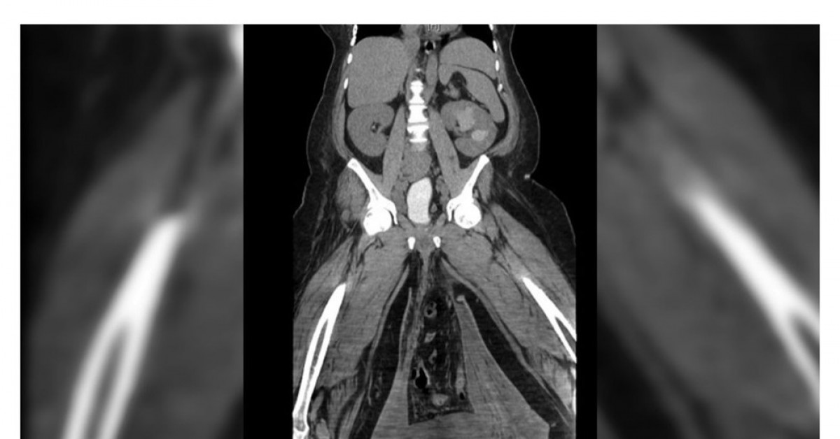 Sức khỏe đời sống - Người đàn ông "vác" tinh hoàn to bằng quả bóng tới bệnh viện