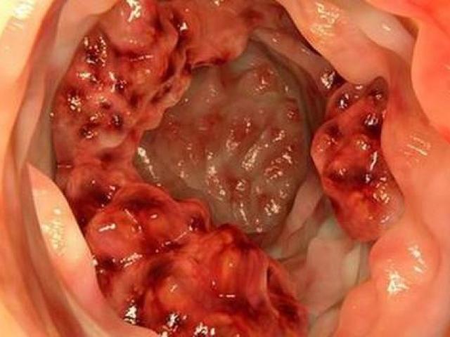 Sức khỏe đời sống - Chủ quan với dấu hiệu, bà mẹ trẻ 2 con mắc ung thư di căn