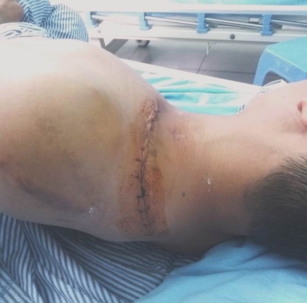 Anh Cao Đức Tuấn bị thương đang điều trị tại bệnh viện