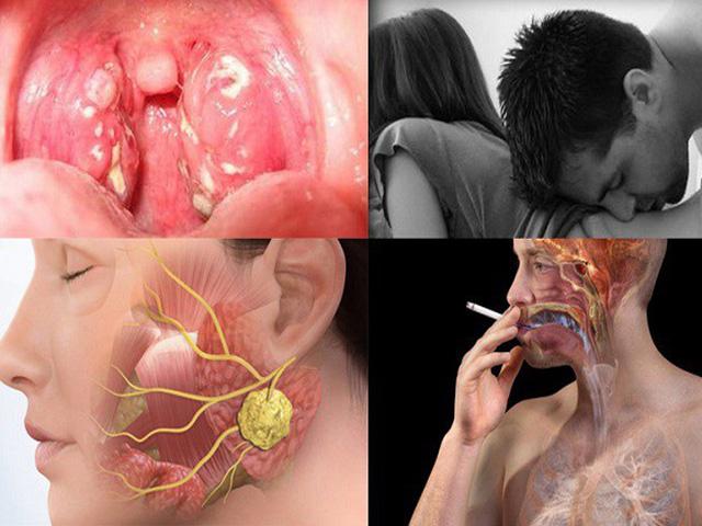 Sức khỏe đời sống - Ngoài "yêu" bằng miệng, đây là những nguyên nhân chính gây ung thư vòm họng