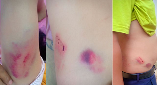 Các vết thương do bị đánh trên người ông Thủy