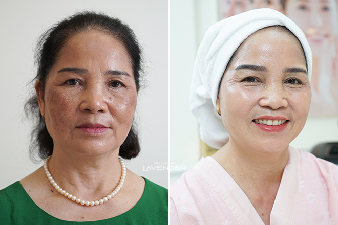 Gương mặt trước và sau khi điều trị nám với Mela Extra 