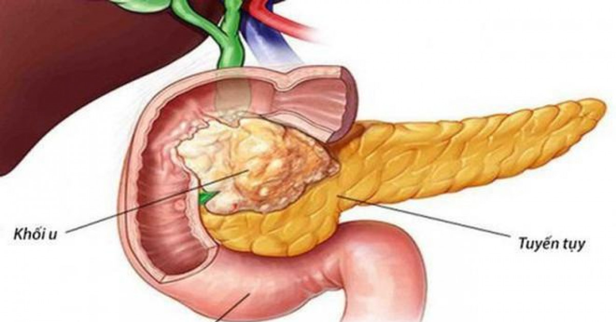 Sức khỏe đời sống - Vàng da: Dấu hiệu cảnh báo căn bệnh ung thư tử thần