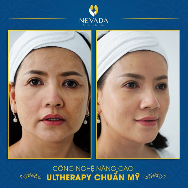 Diễn viên Ngọc Trinh sau khi nâng cơ trẻ hóa da Ultherapy
